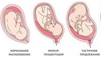 Предлежание плаценты при беременности: что это, классификация и варианты родоразрешения